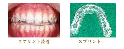 顎関節症のプロセスのイメージ